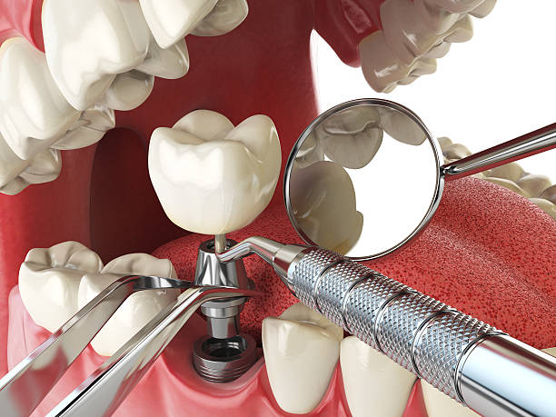 Best Urgent Care for Lost Fillings or Crowns in Delray Beach, FL