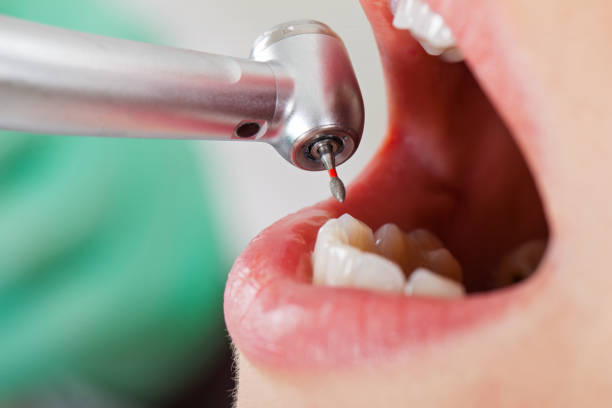 Best Emergency Treatment for Dental Infections or Abscesses in Delray Beach, FL